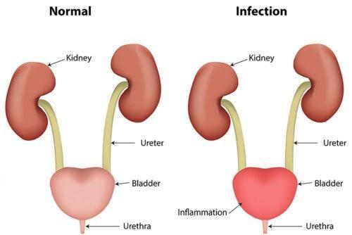 6 possible causes of burning sensation after peeing with no infection