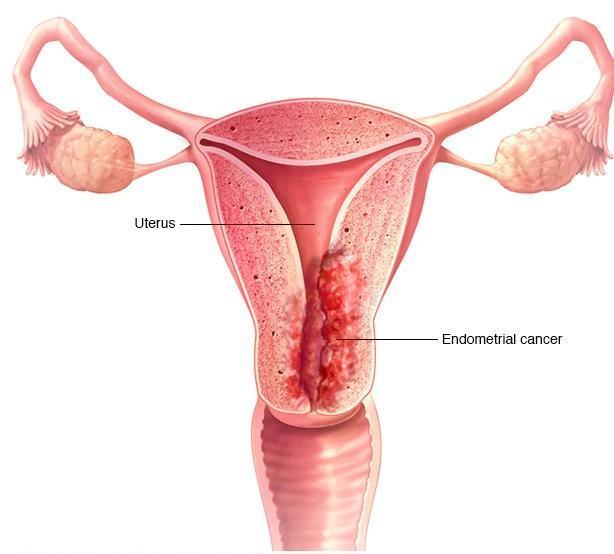 Uterine And Endometrial Cancer Screening 7903