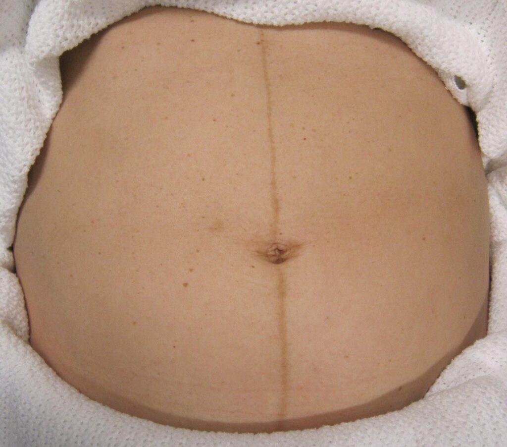 Linea nigra - A line of skin running from belly button to pubic hairline -  