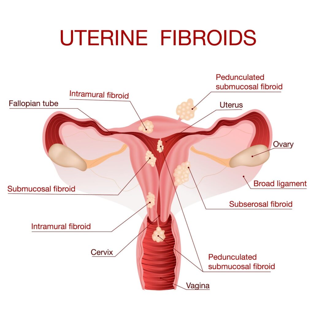 Uterine Fibroids narikaa