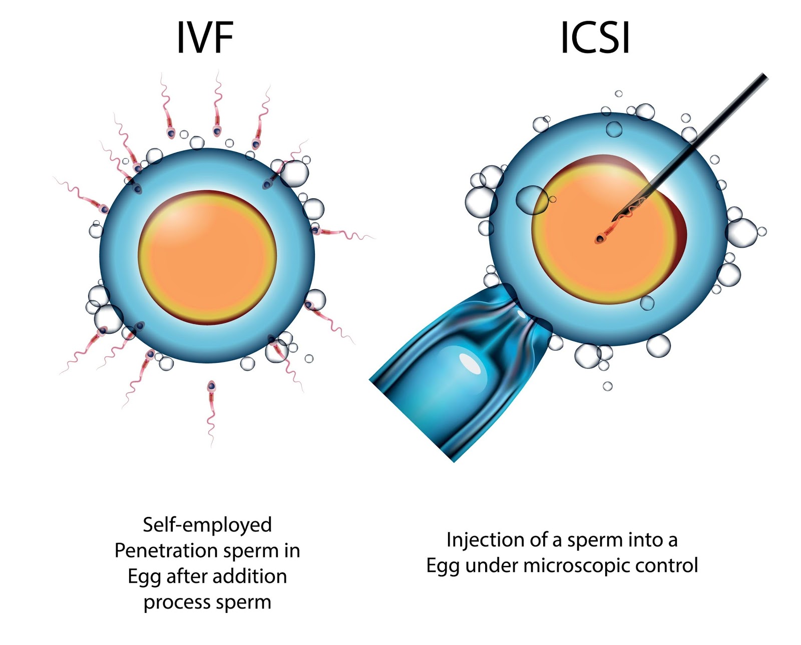 Is ICSI better than IVF?