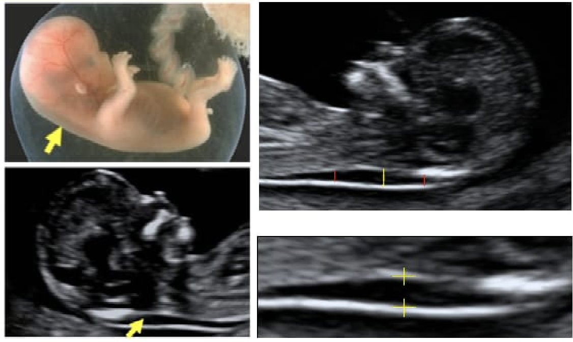 ultrasound findings in first trimester of pregnancy